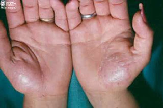 El tratamiento de la psoriasis harkove